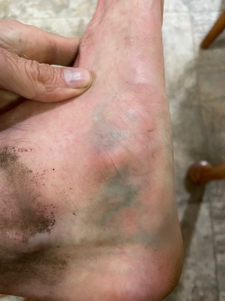 My foot, which has inexplicably turned blue